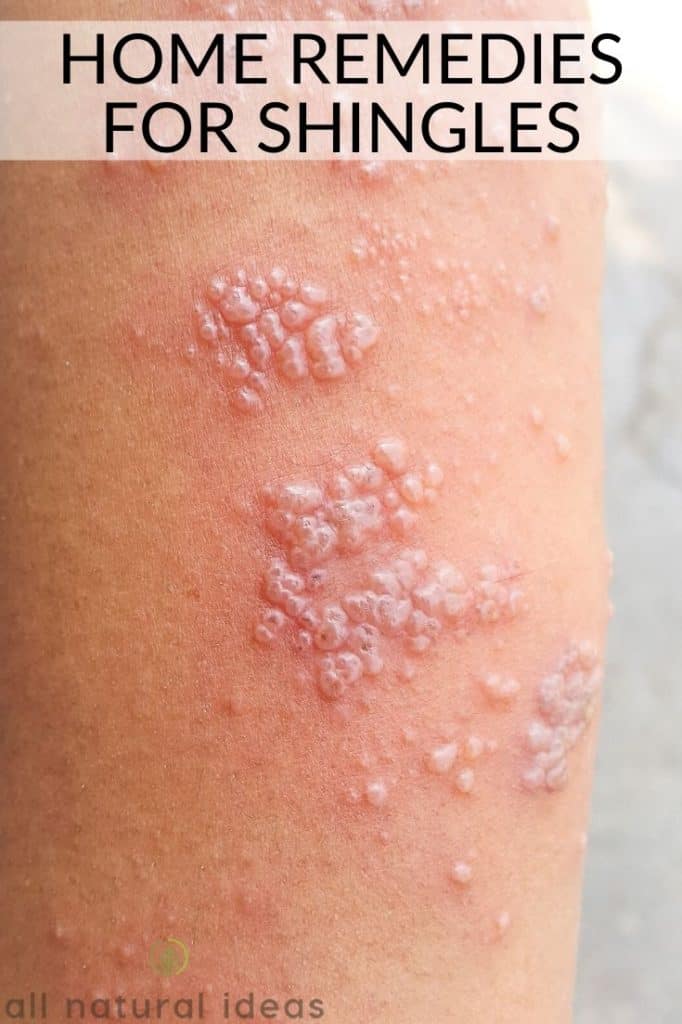 home remedies shingles