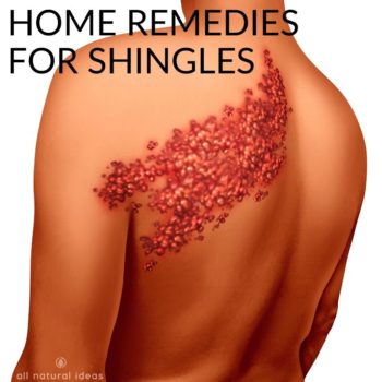 shingles home remedies