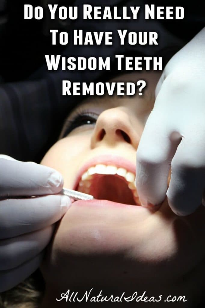 Wisdom Teeth Surgery: Is it really necessary? | All Natural Ideas