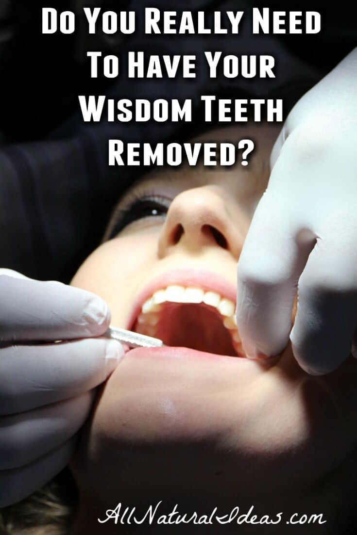 Do you have to get your wisdom teeth removed?