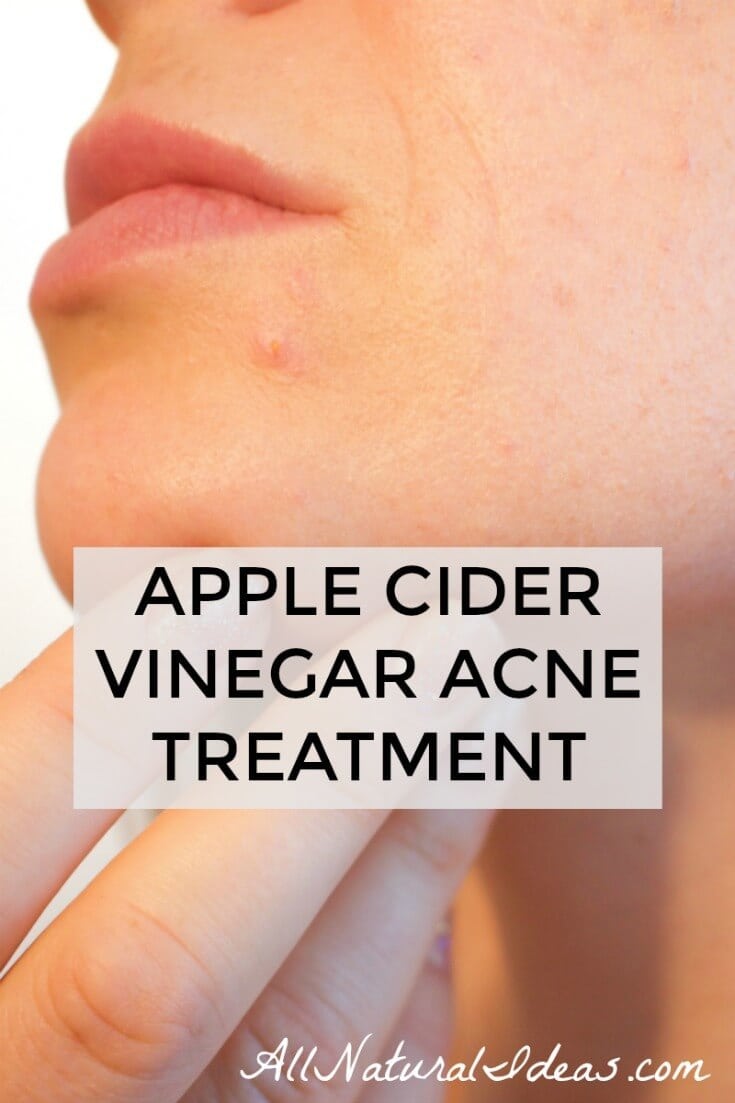 apple cider vinegar acne treatment