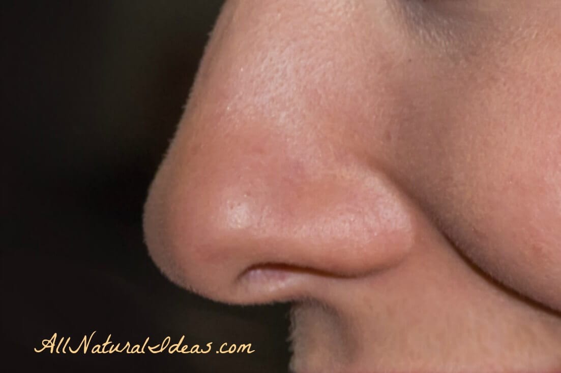 How to get rid of blackheads on nose