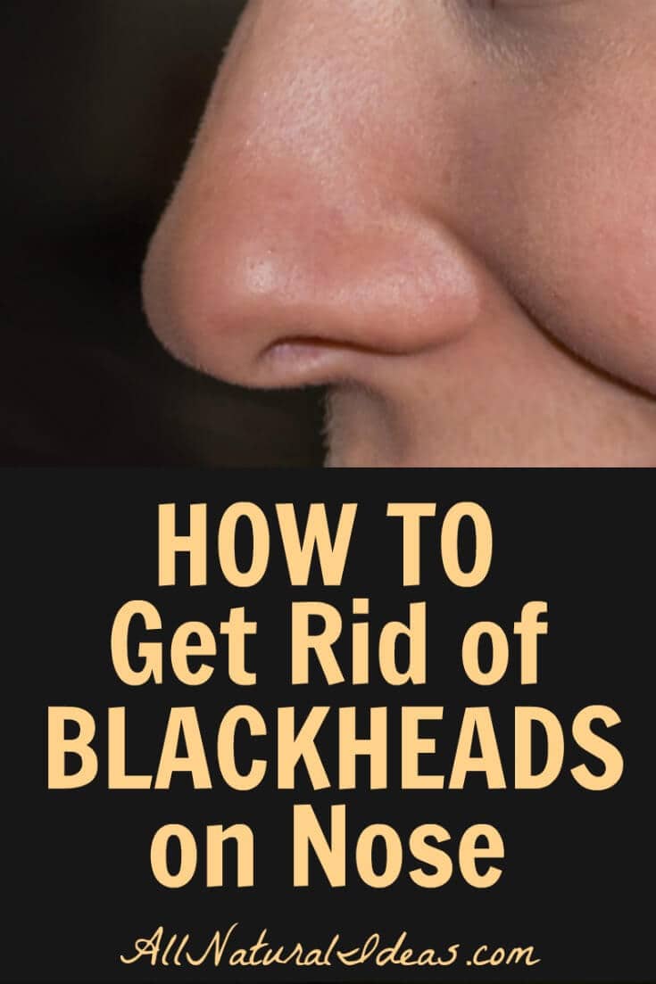 Are you struggling with how to get rid of blackheads on nose? This form of acne can be prevented and treated using a variety of all natural solutions. | allnaturalideas.com