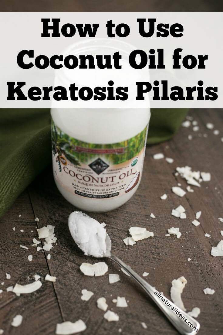 Coconut oil for keratosis pilaris