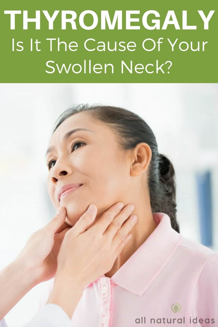 What is thyromegaly - swollen thyroid