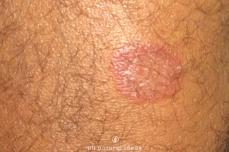 How to get rid of ringworm fast using natural methods