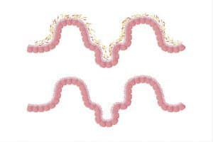 Leaky Gut Syndrome Test: is it even necessary? | All Natural Ideas