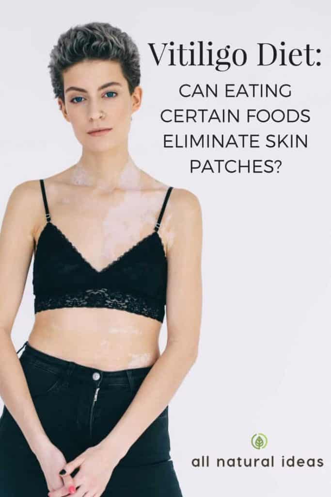 vitiligo-diet-can-certain-foods-eliminate-patches-all-natural-ideas