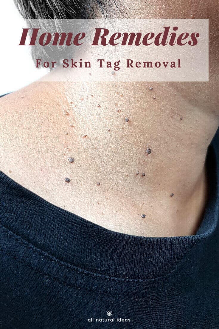 remove skin tags